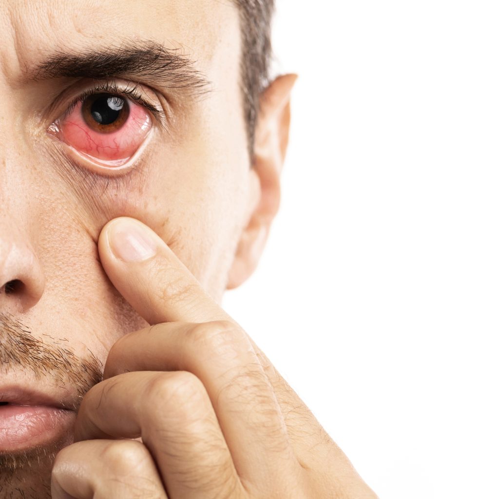 Eye Bleeding(Hyphema) Causes, Symptoms and Treatment sightconnection