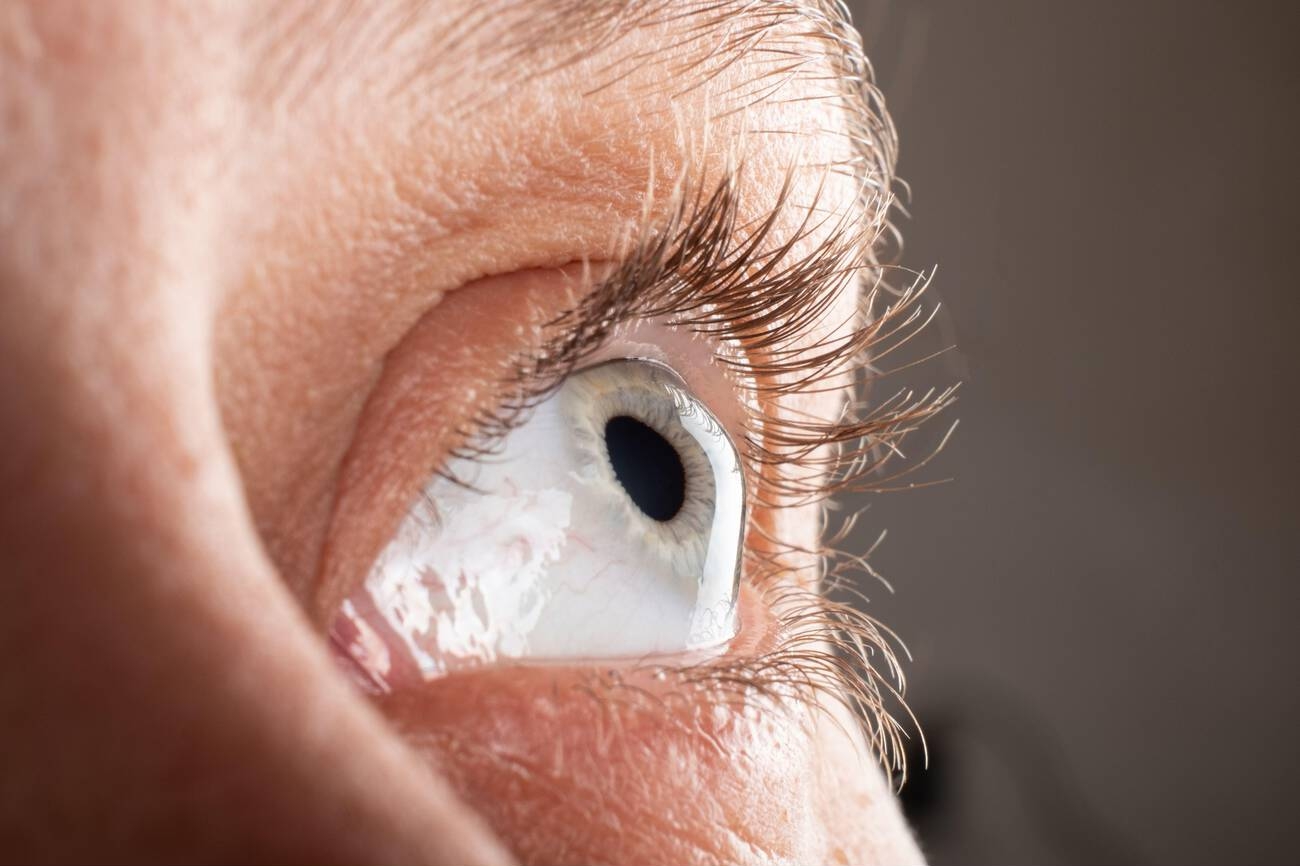 Living With Keratoconus: Causes, Symptoms and Treatment