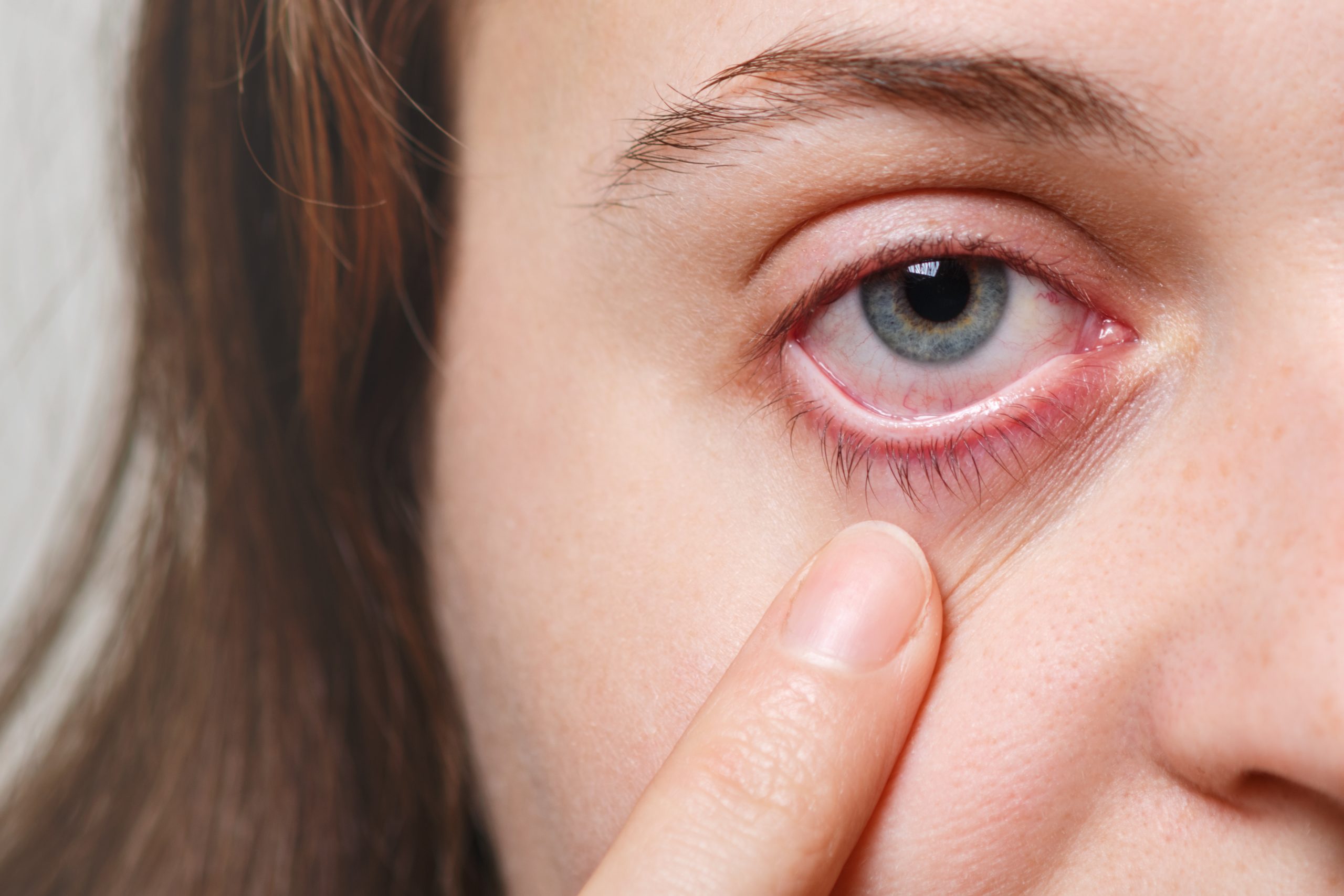 Pink Eye(Conjunctivitis) Causes, Symptoms and Treatment
