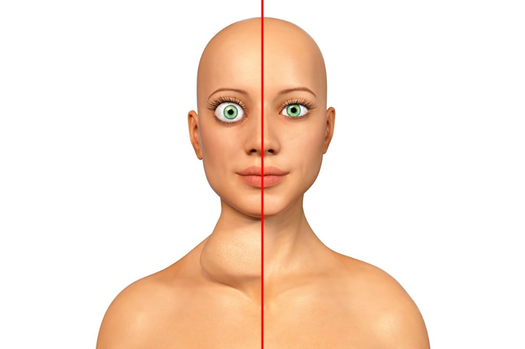 The Link Between Hyperthyroidism and Protruding or Buggy Eyes