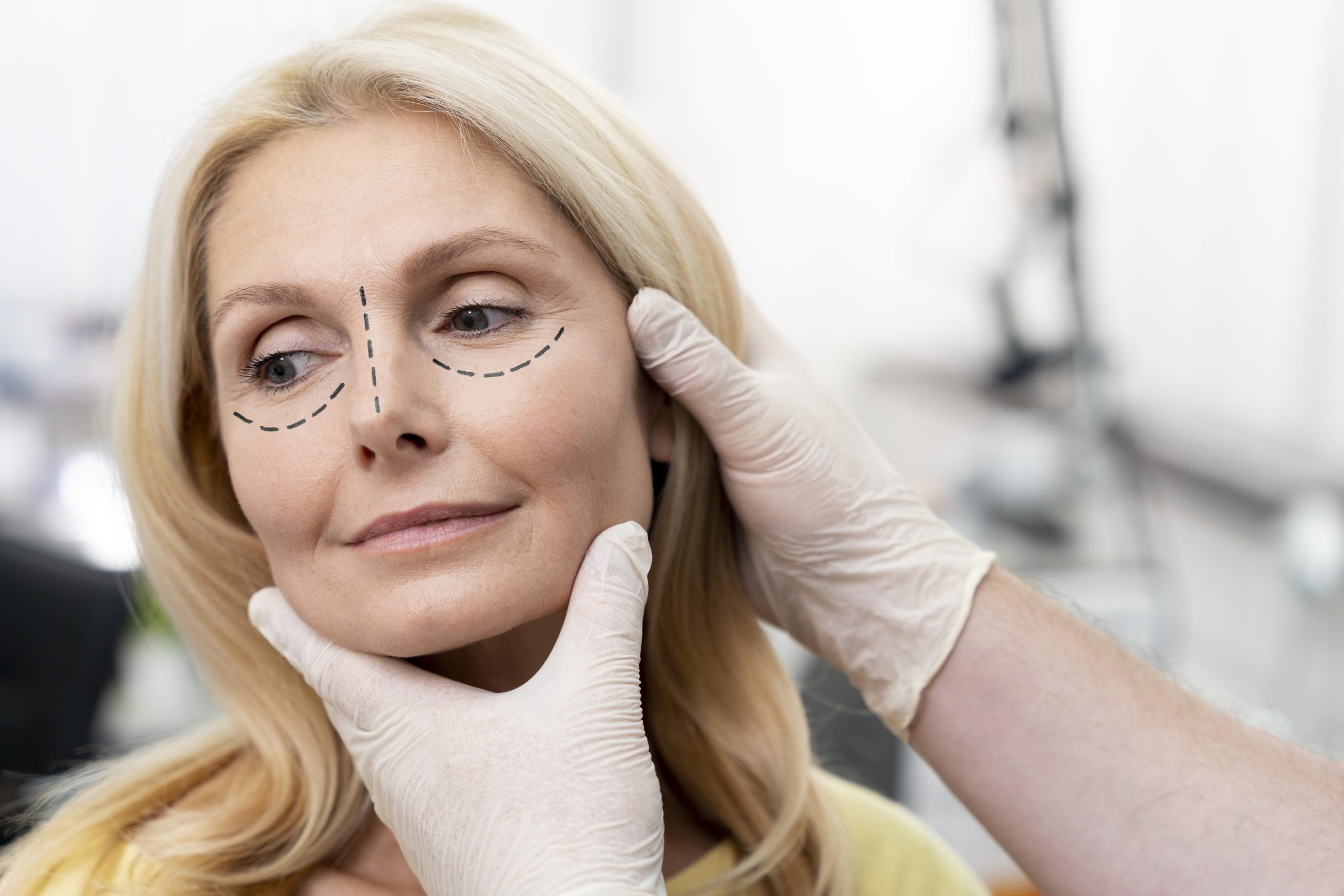 Upper Blepharoplasty Unveiled A Comprehensive Guide to Eyelid Rejuvenation Surgery
