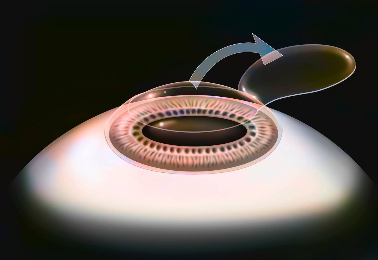 What To Expect During A Lasik Eye Surgery