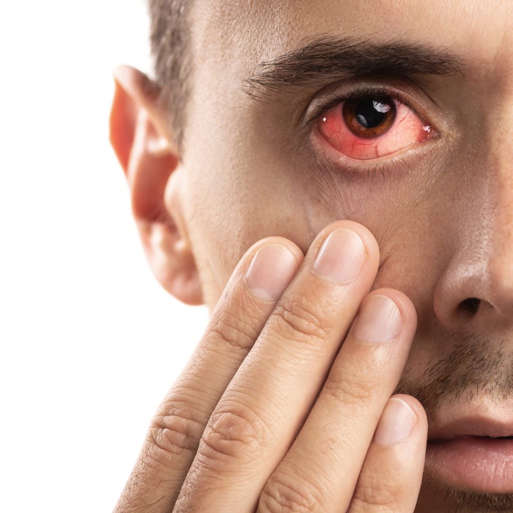 Chemical Eye Burn: Causes, Symptoms, and Treatment Options ...