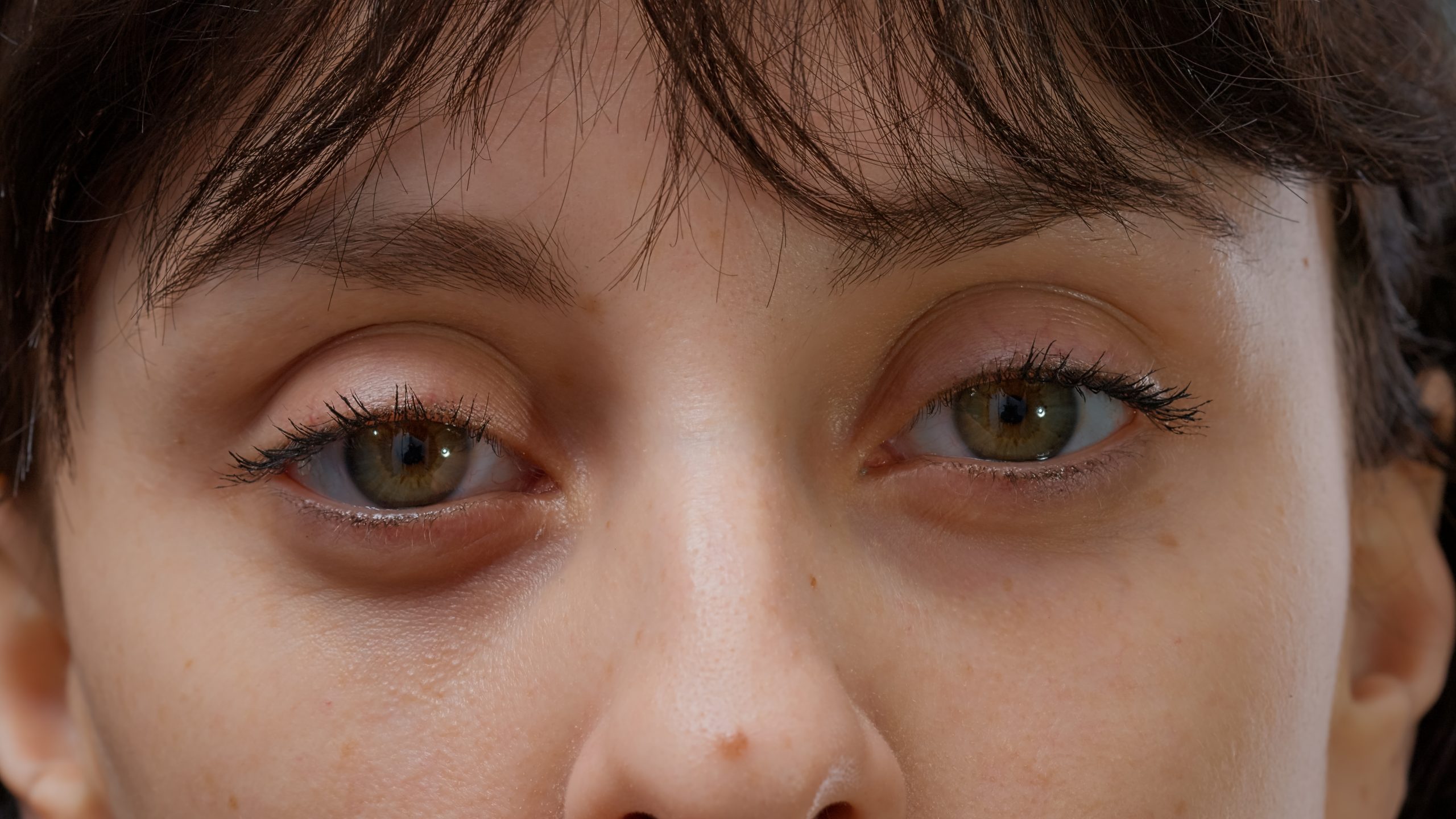 Eyelid Dermatitis A Closer Look at Contact, Symptoms, and Treatment