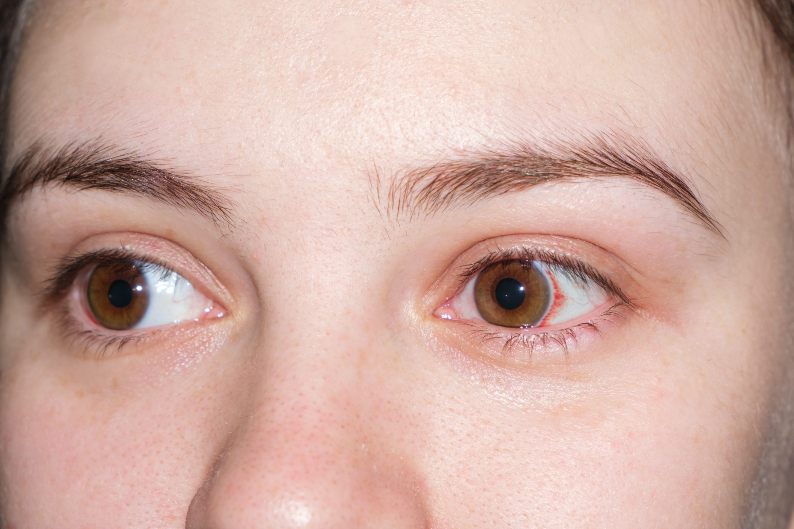 xerophthalmia Definition, Causes and Treatment