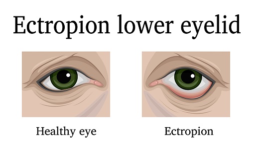 What are the 4 types of entropion