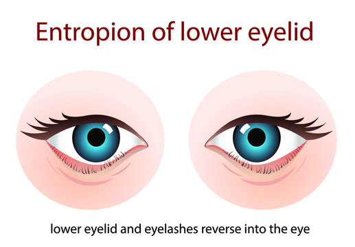 What causes entropion