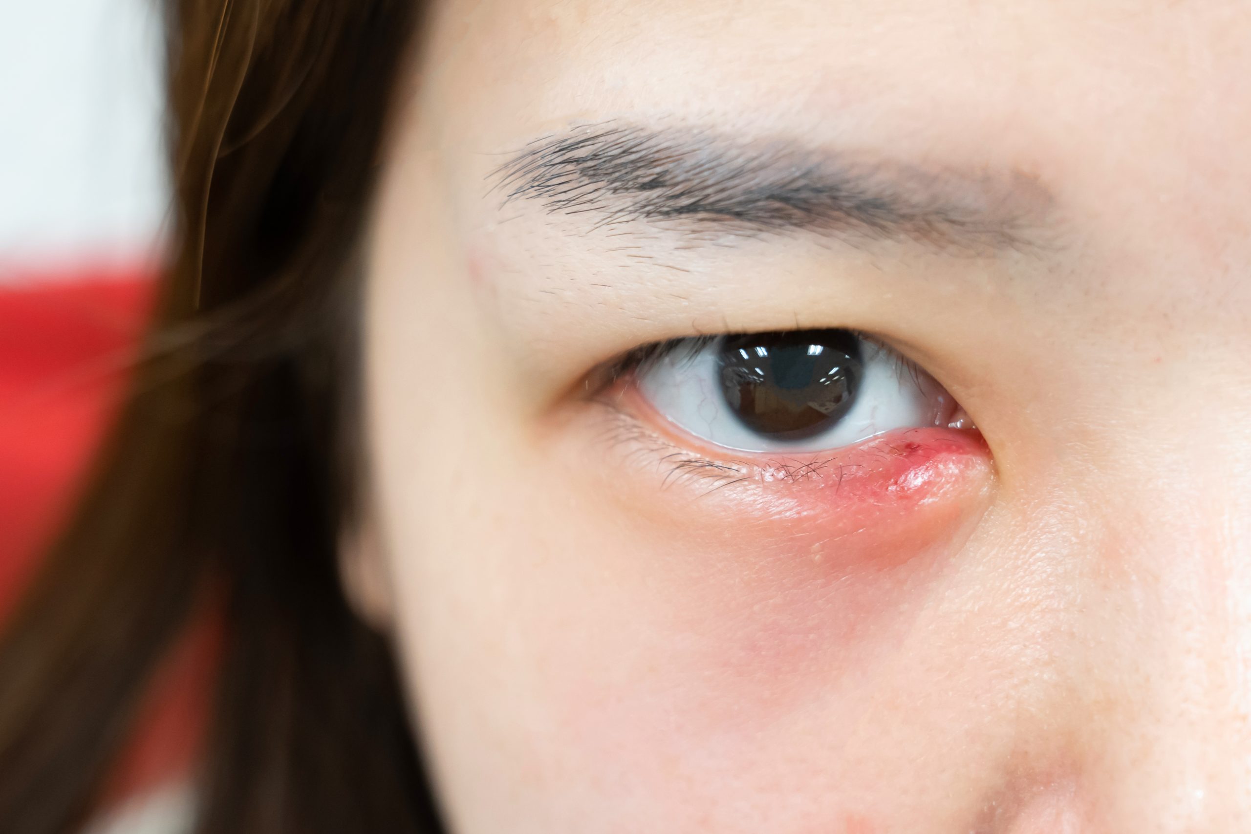 What Causes Styes in Eyes and How To Cure Them