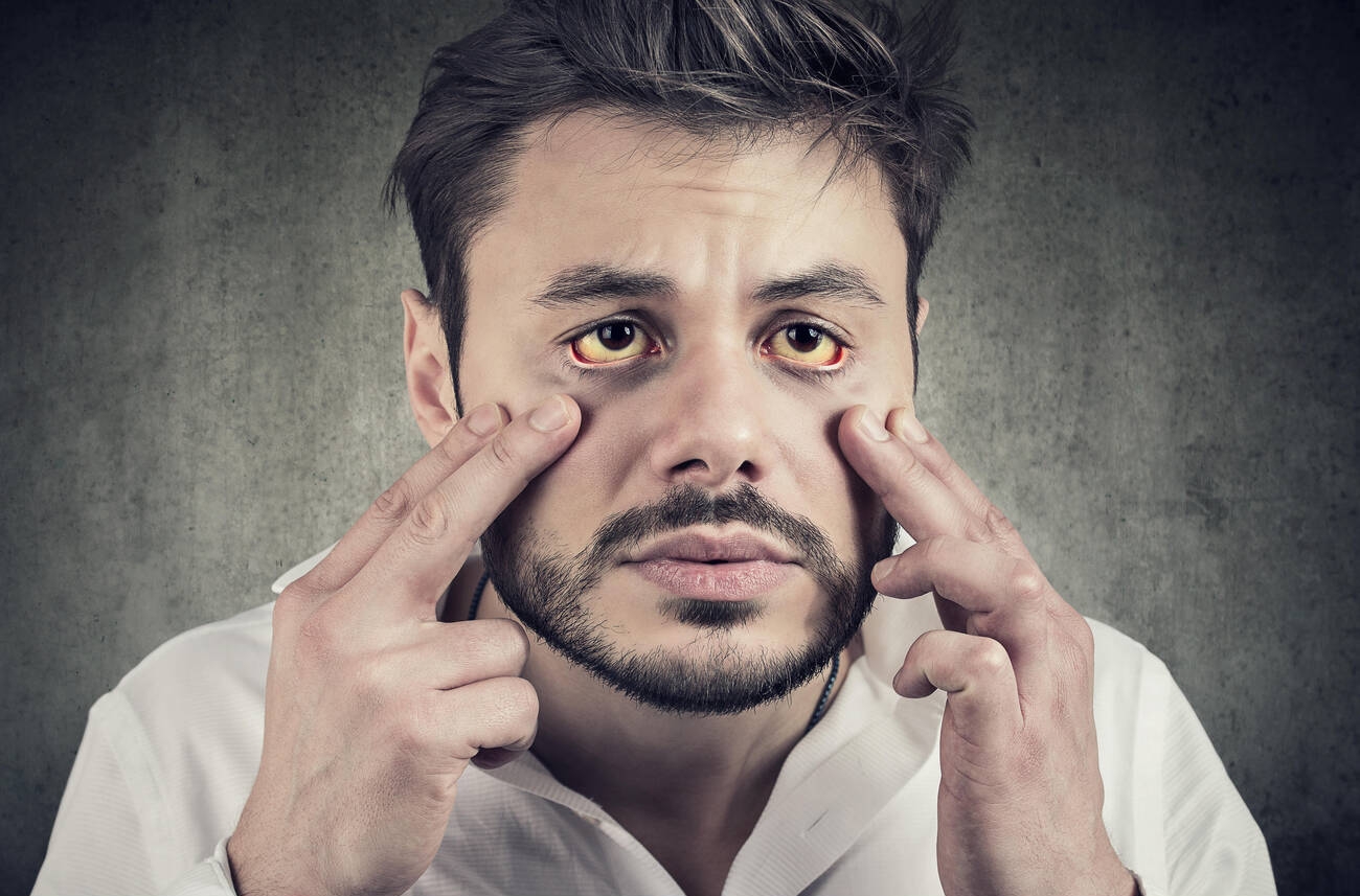 Why Do Smoking Eyes Look Yellow And How To Whiten Them
