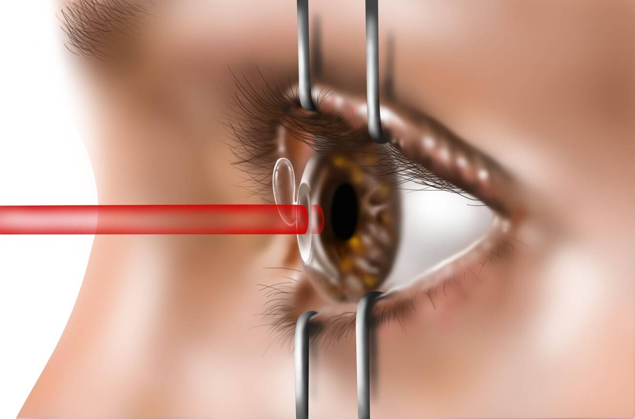 Everything You Need To Know About Laser Surgery For Vision Correction