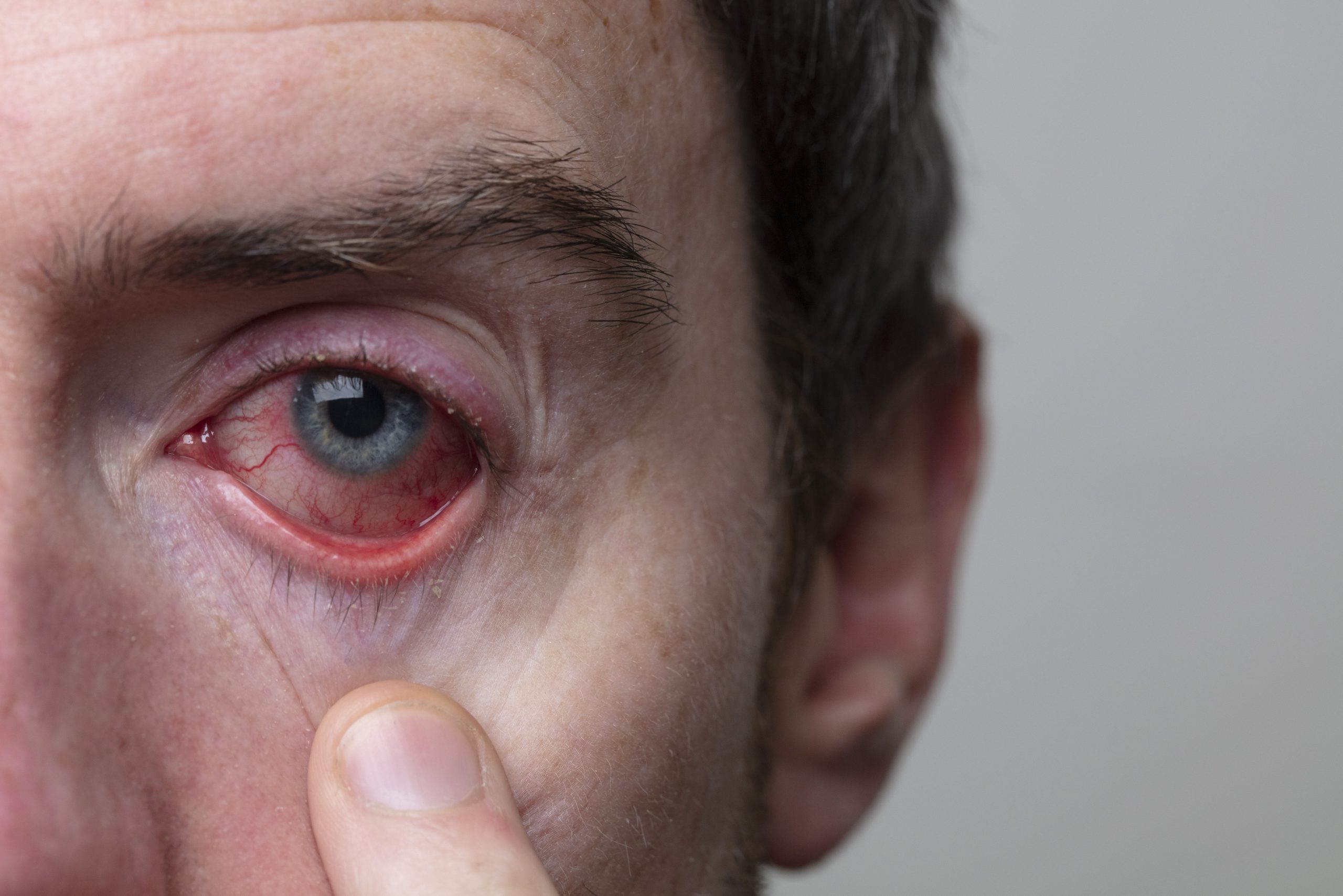Uveitis- Causes, Symptoms and Treatment