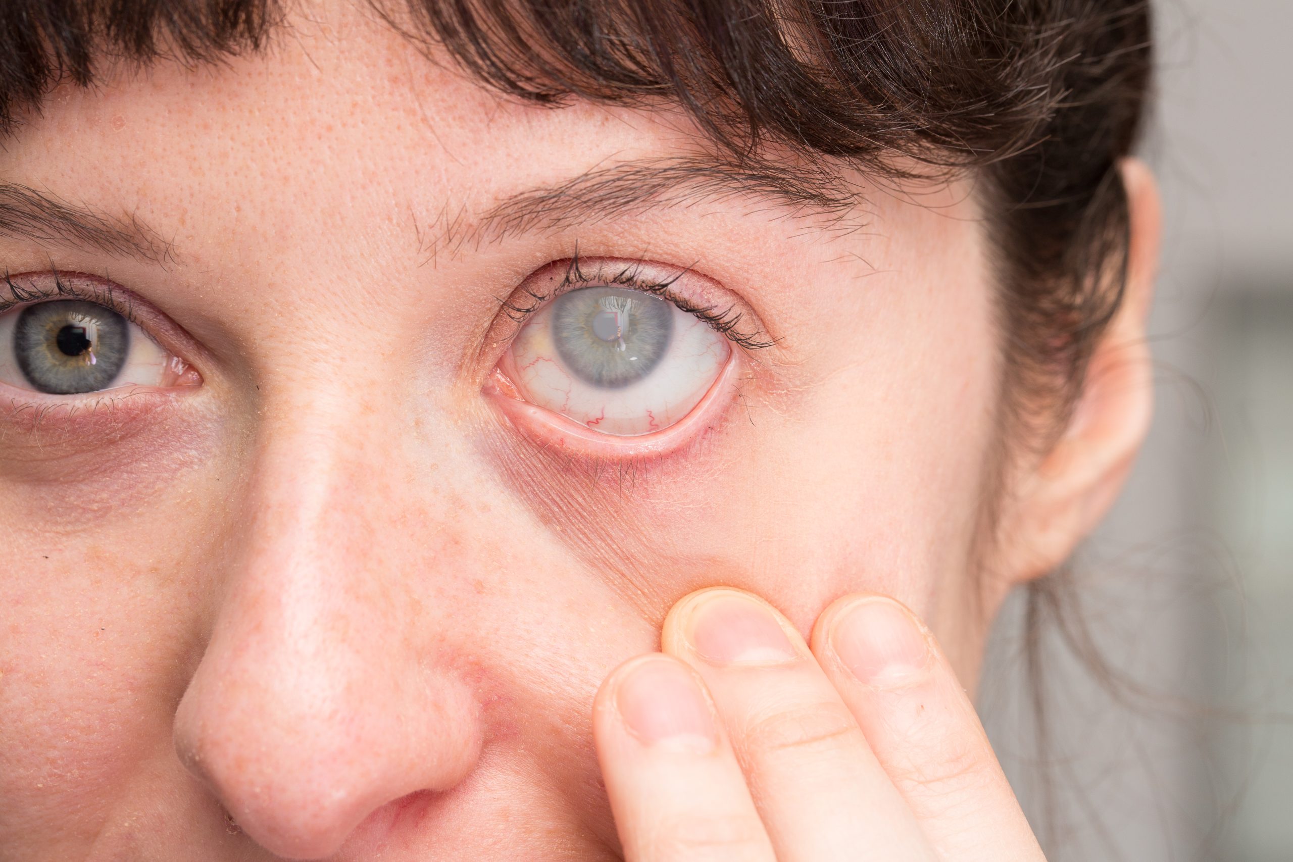 Corneal Ulcer Causes, Symptoms, and Treatment Options