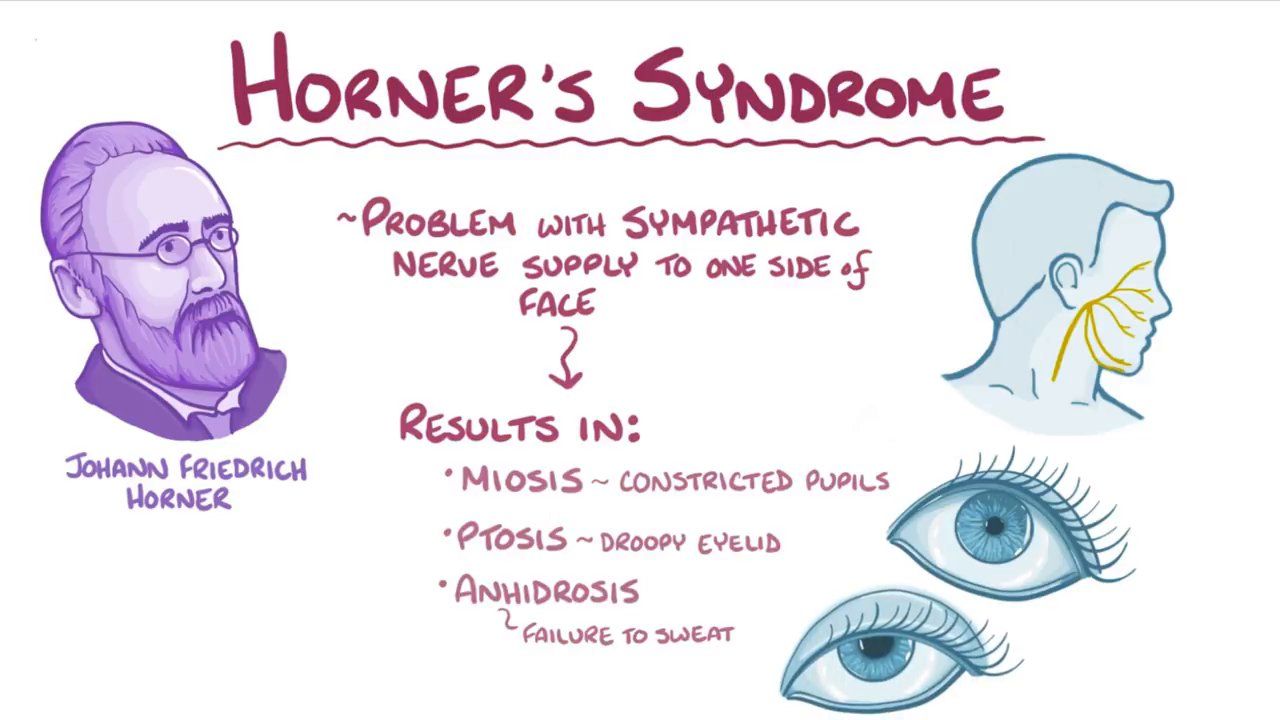 Which nerve root is affected in Horner syndrome