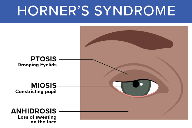 symptoms of horner's syndrome